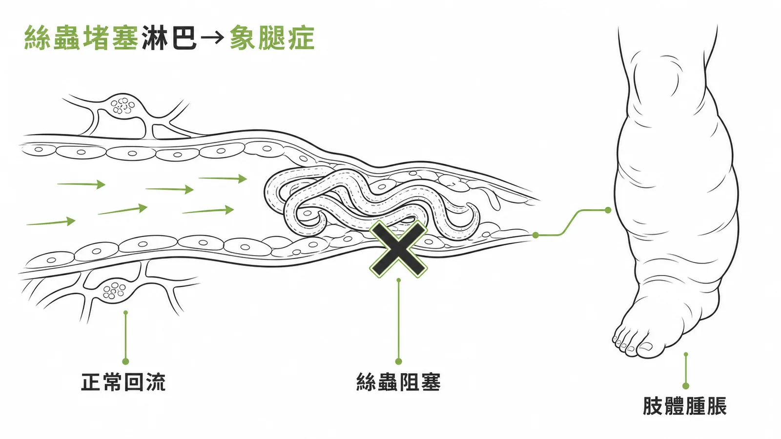 絲蟲堵塞淋巴管導致象腿症的機轉示意圖
