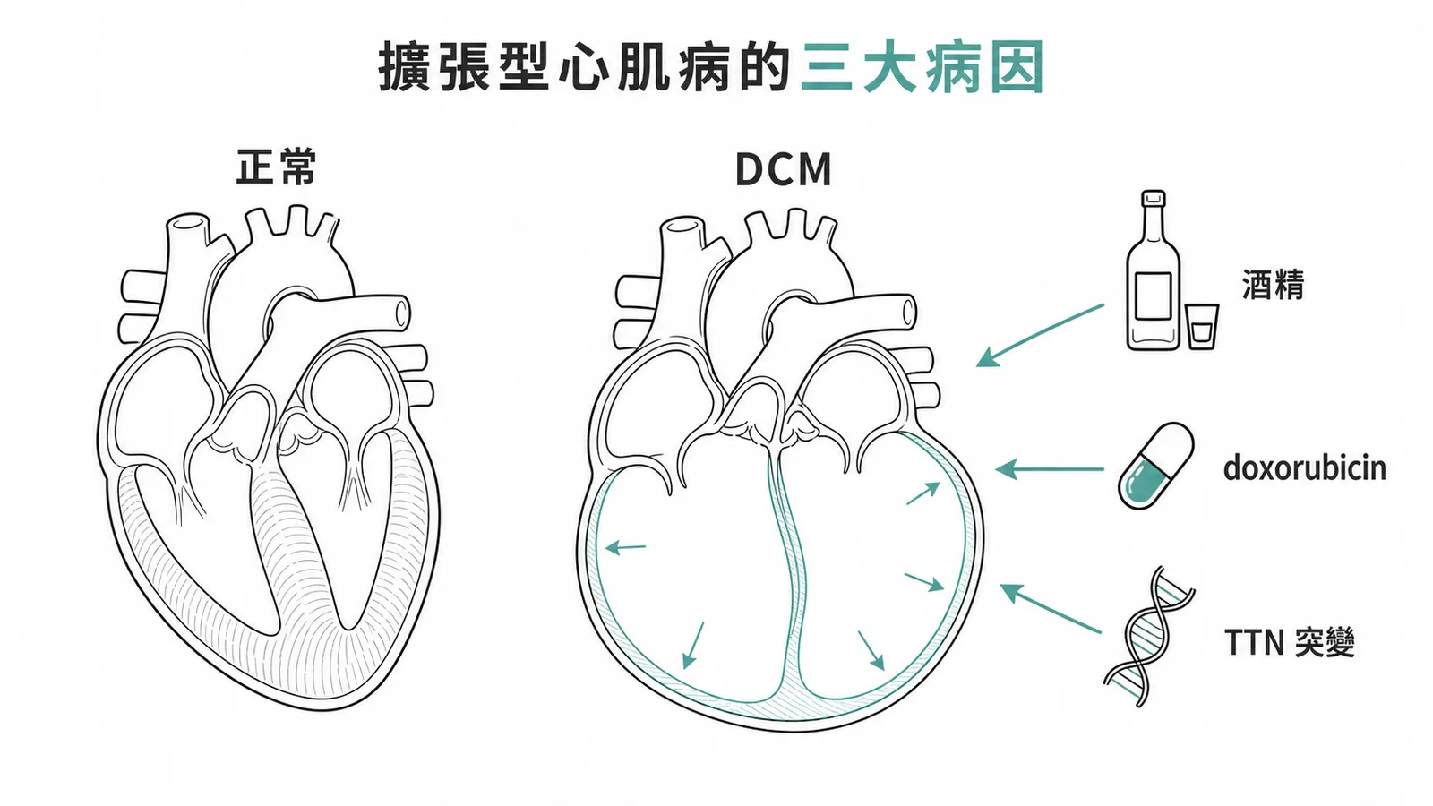 擴張型心肌病三大病因示意圖