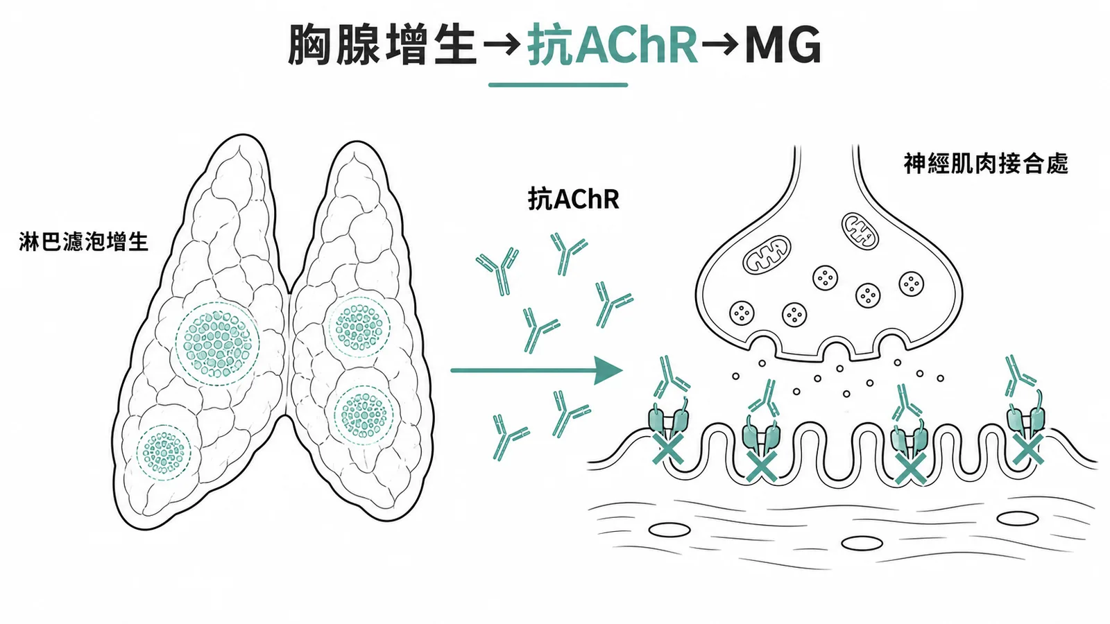胸腺增生產生抗AChR抗體導致重症肌無力的機轉