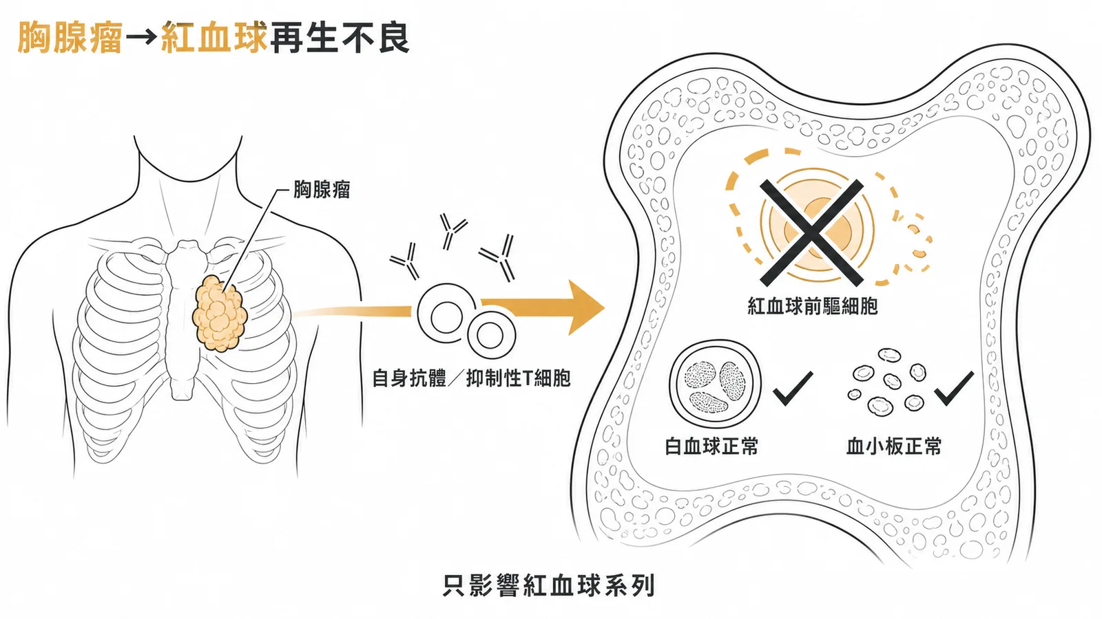 胸腺瘤導致純紅血球再生不良的機轉