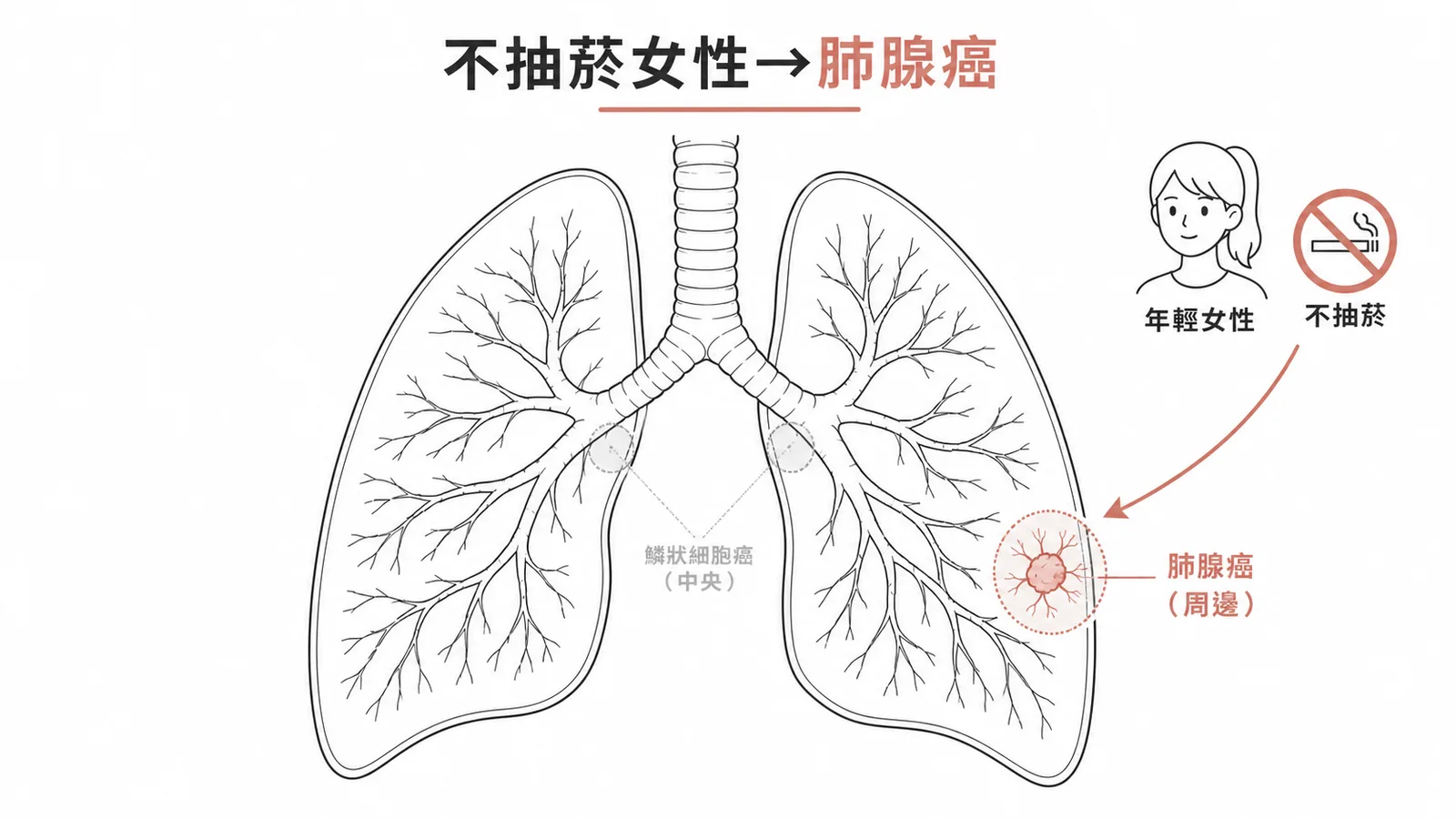 不抽菸年輕女性最常見肺癌為肺腺癌