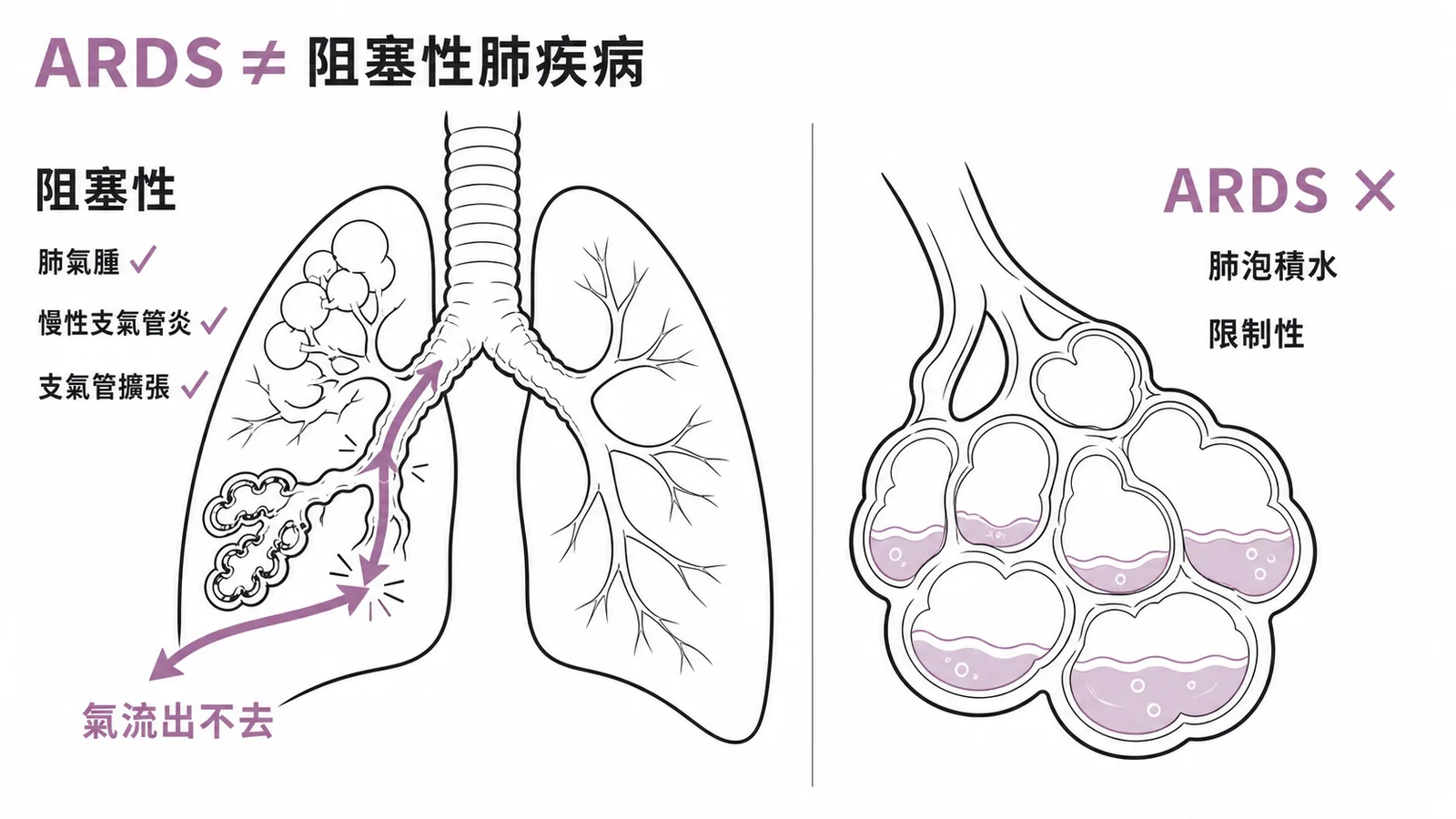 ARDS屬限制性非阻塞性肺疾病對照圖
