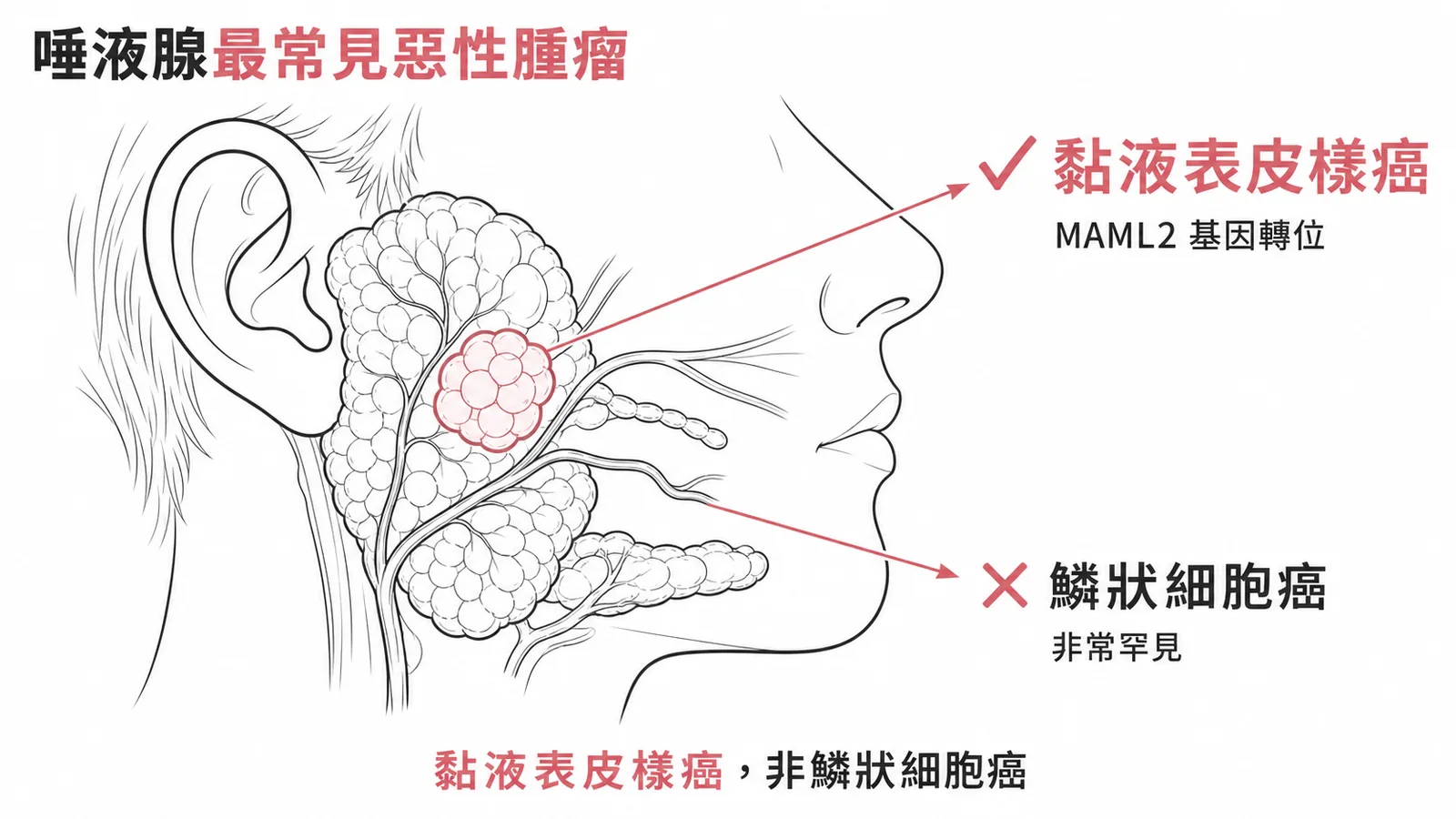唾液腺最常見惡性腫瘤為黏液表皮樣癌而非鱗狀細胞癌