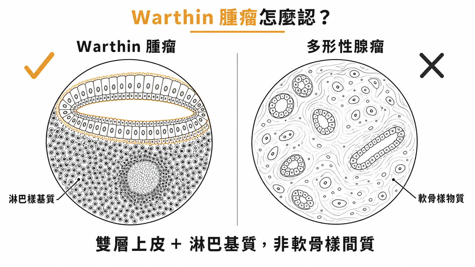 Warthin腫瘤的組織學特徵為雙層上皮與淋巴基質，區別於多形性腺瘤的軟骨樣間質