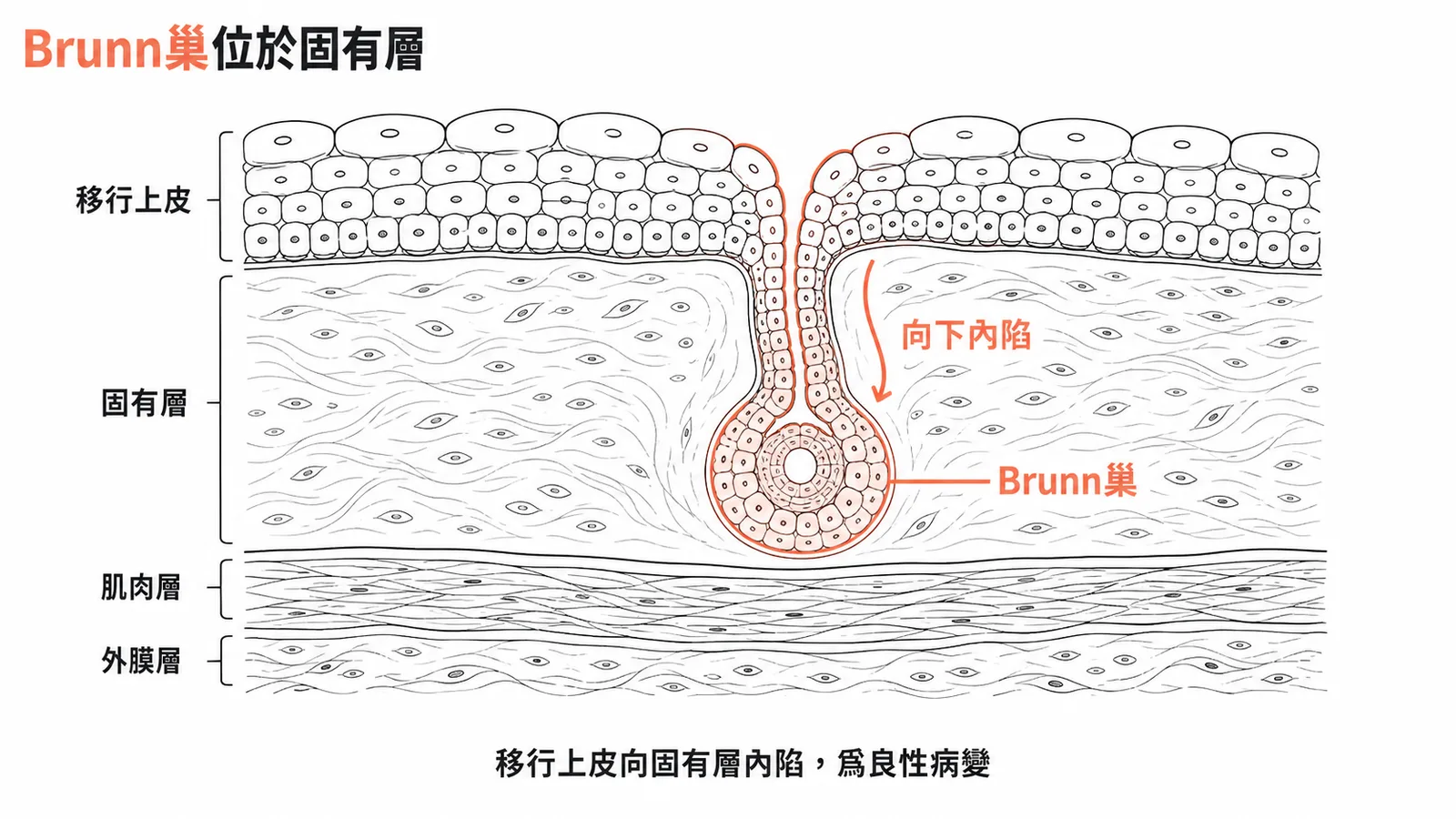 Brunn巢位於膀胱固有層，為移行上皮向下內陷形成的良性病變