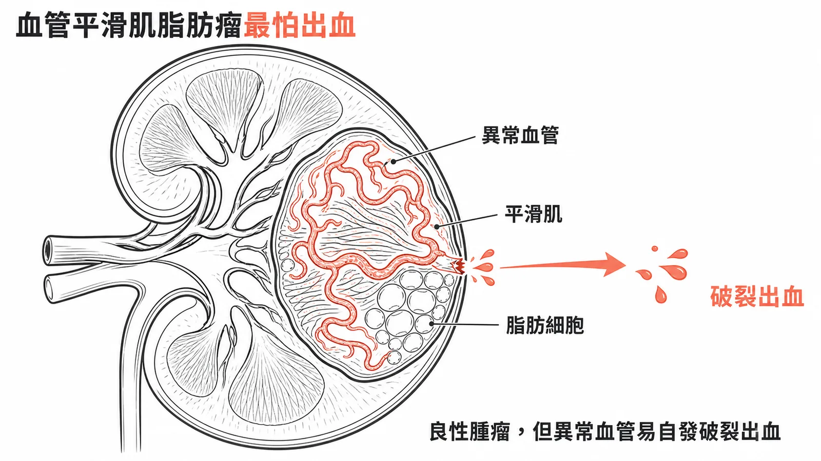 腎臟血管平滑肌脂肪瘤為良性腫瘤但異常血管易自發破裂出血