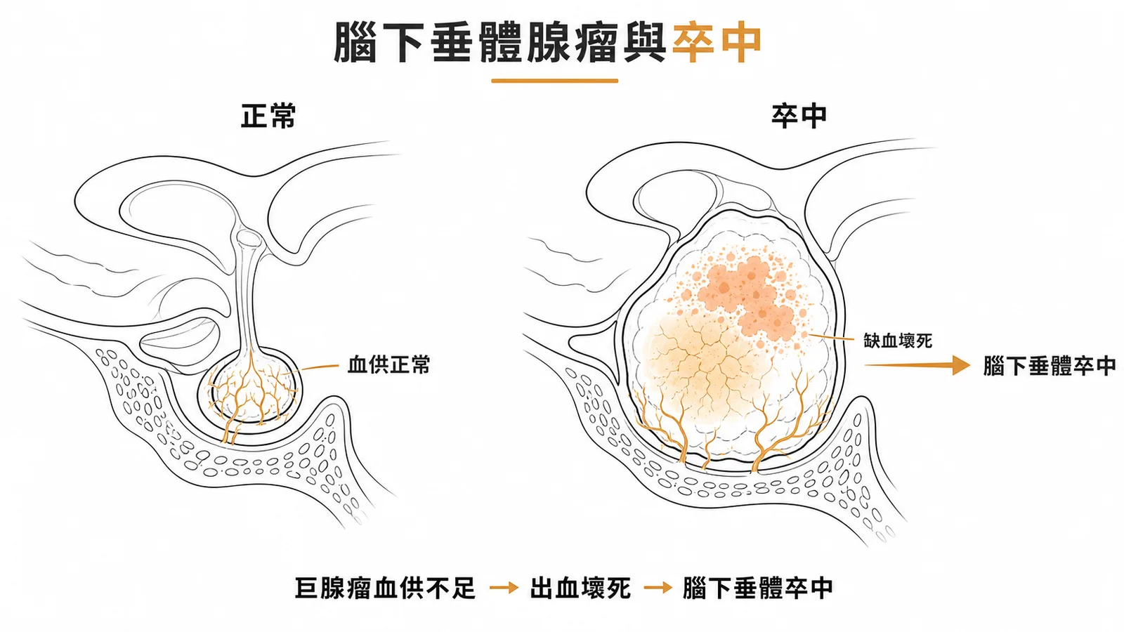 腦下垂體巨腺瘤血供不足導致出血壞死即腦下垂體卒中
