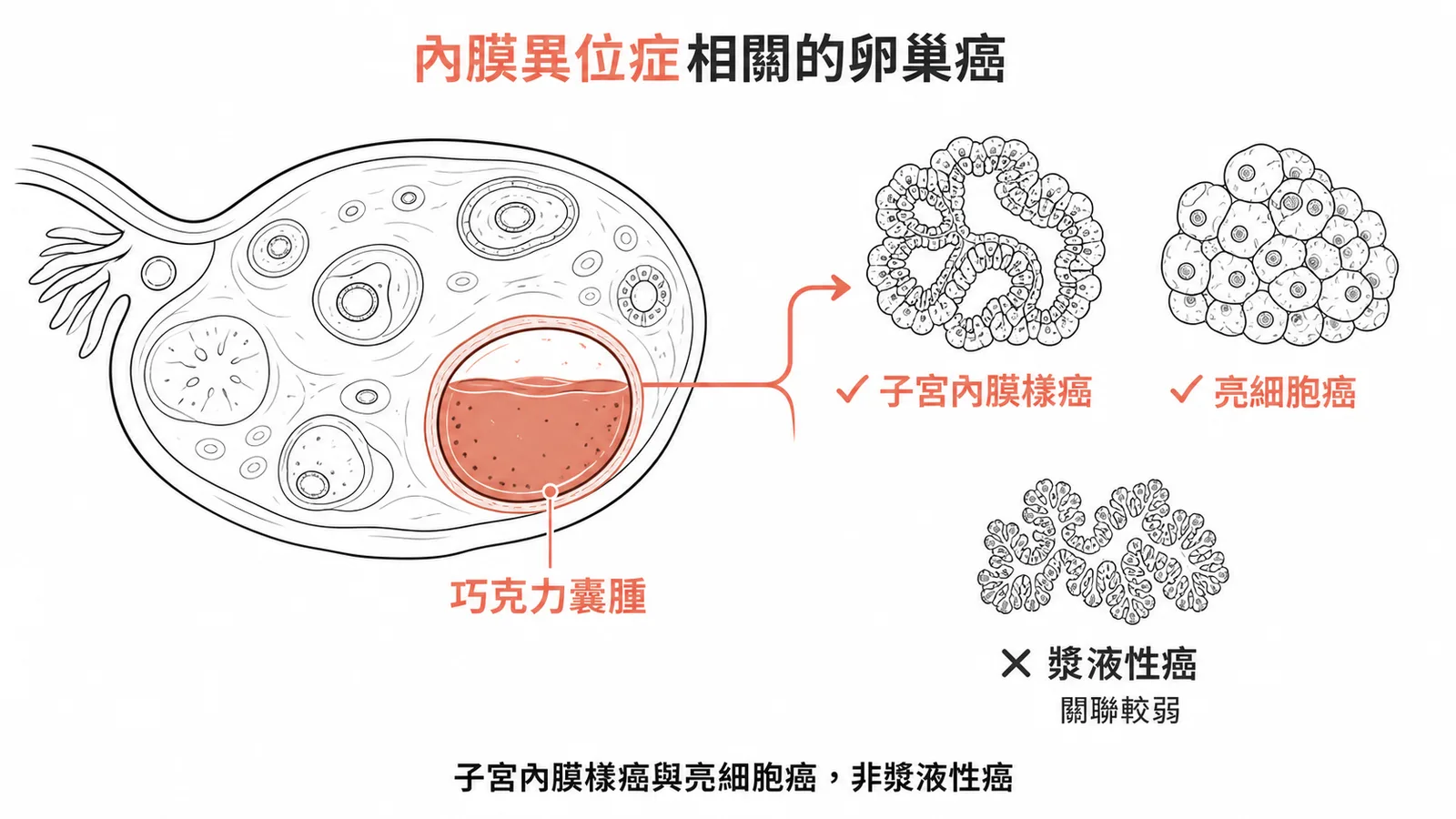 子宮內膜異位症相關卵巢癌為子宮內膜樣癌與亮細胞癌而非漿液性癌