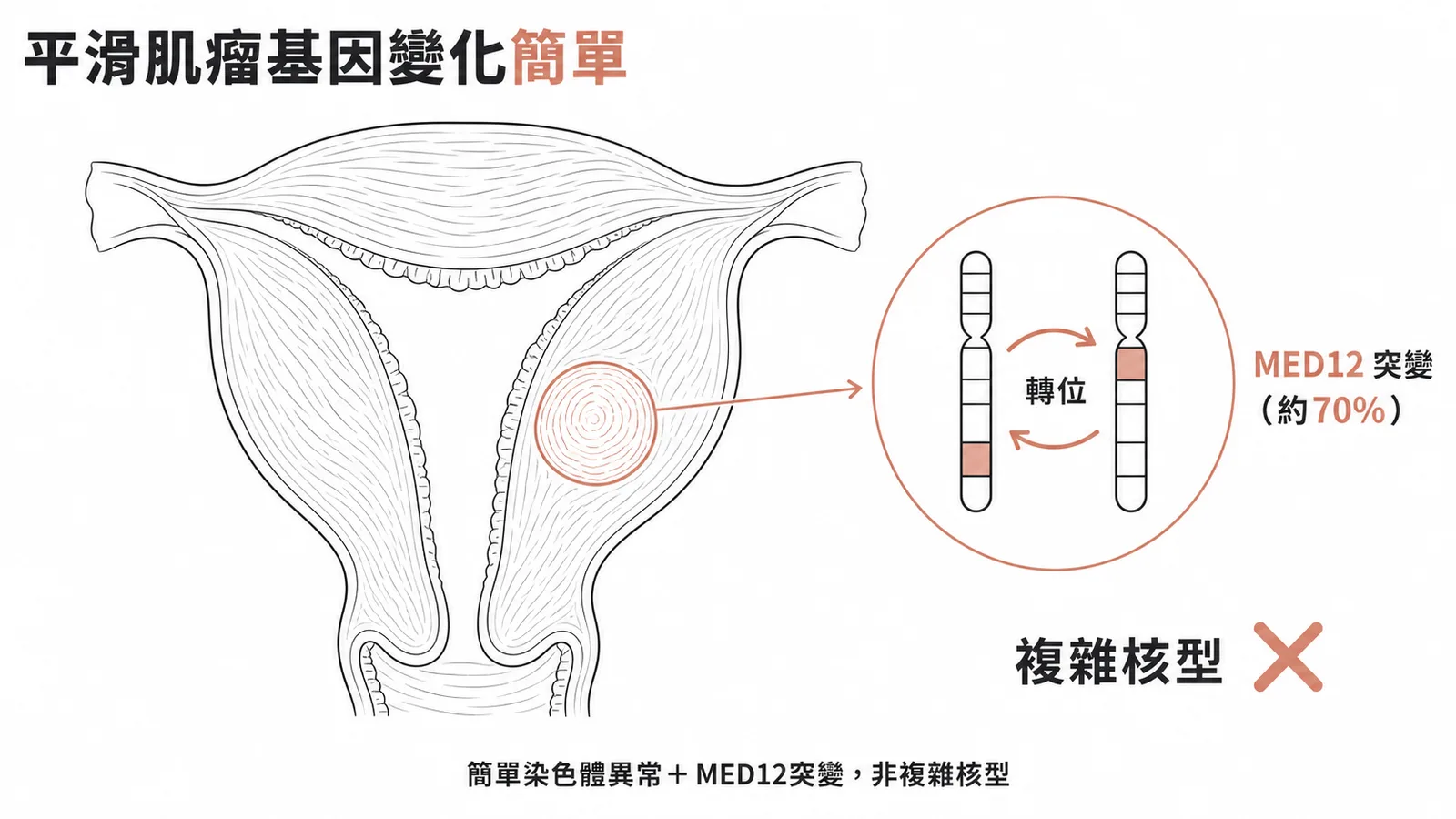 子宮平滑肌瘤的基因變化為簡單染色體異常加MED12突變而非複雜核型