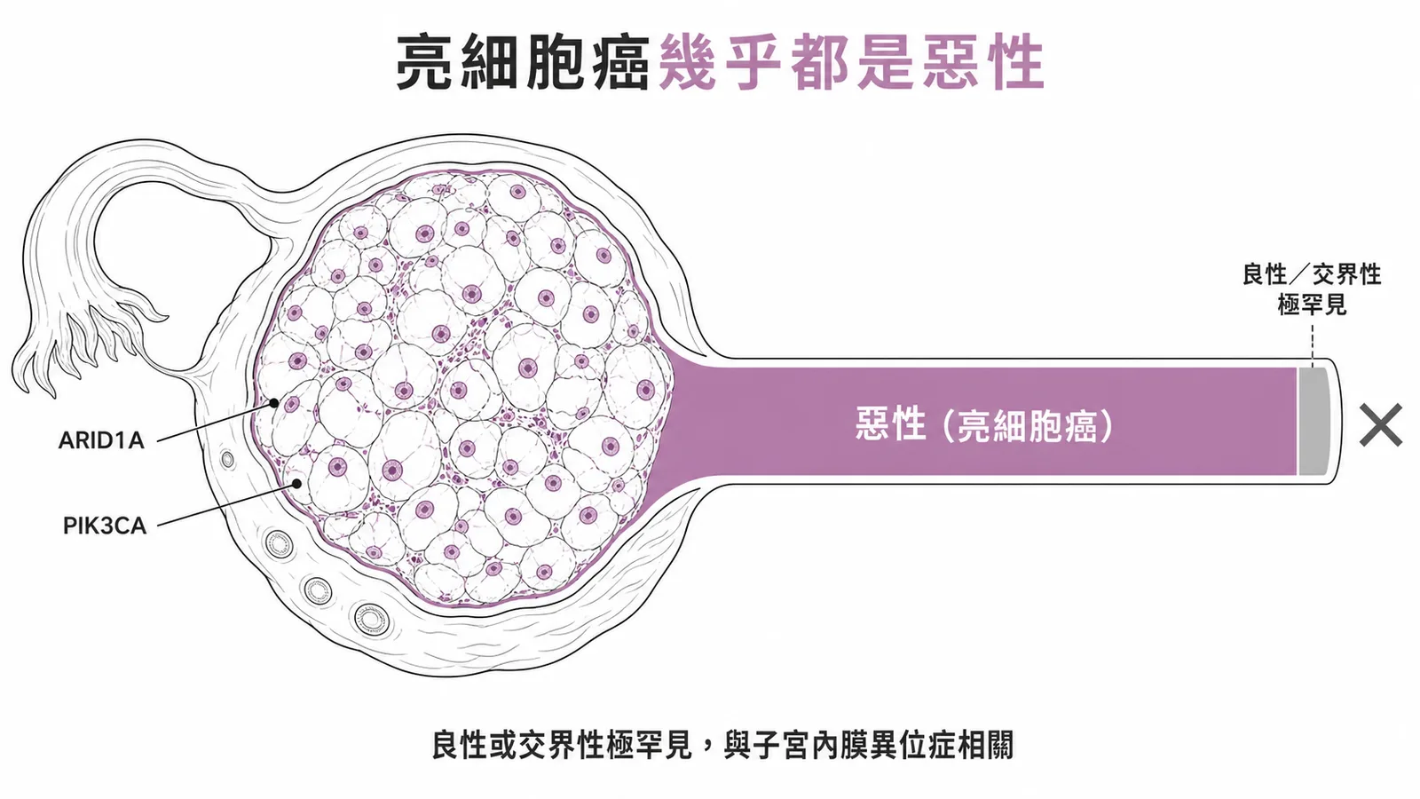卵巢亮細胞癌幾乎都是惡性，良性或交界性極罕見