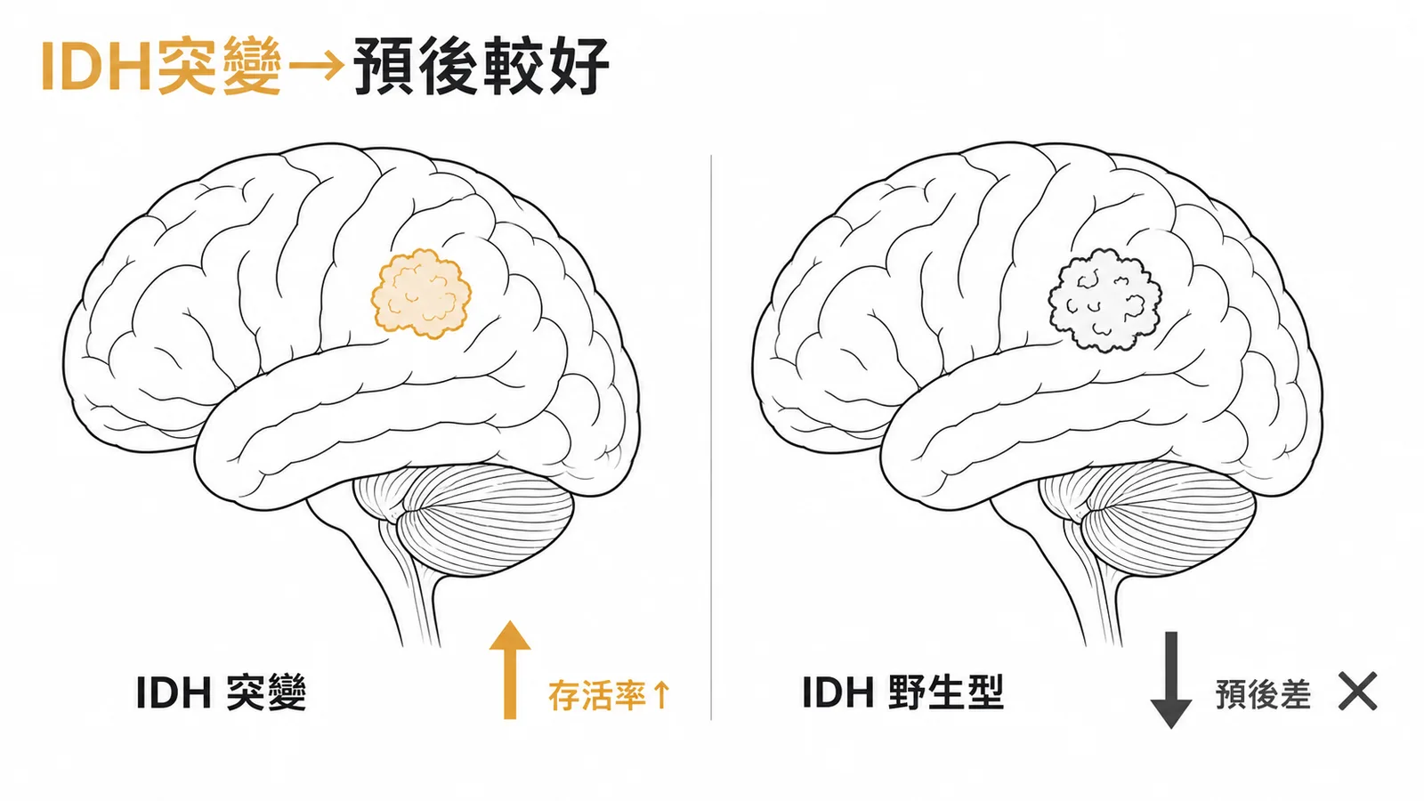 IDH突變型膠質瘤預後較好，對比IDH野生型預後差
