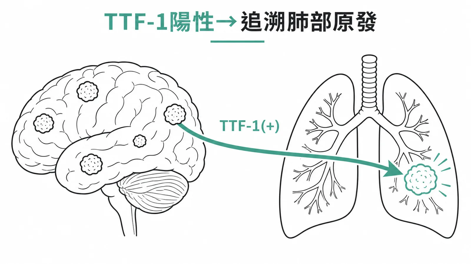 TTF-1陽性追溯腦轉移原發灶來自肺部