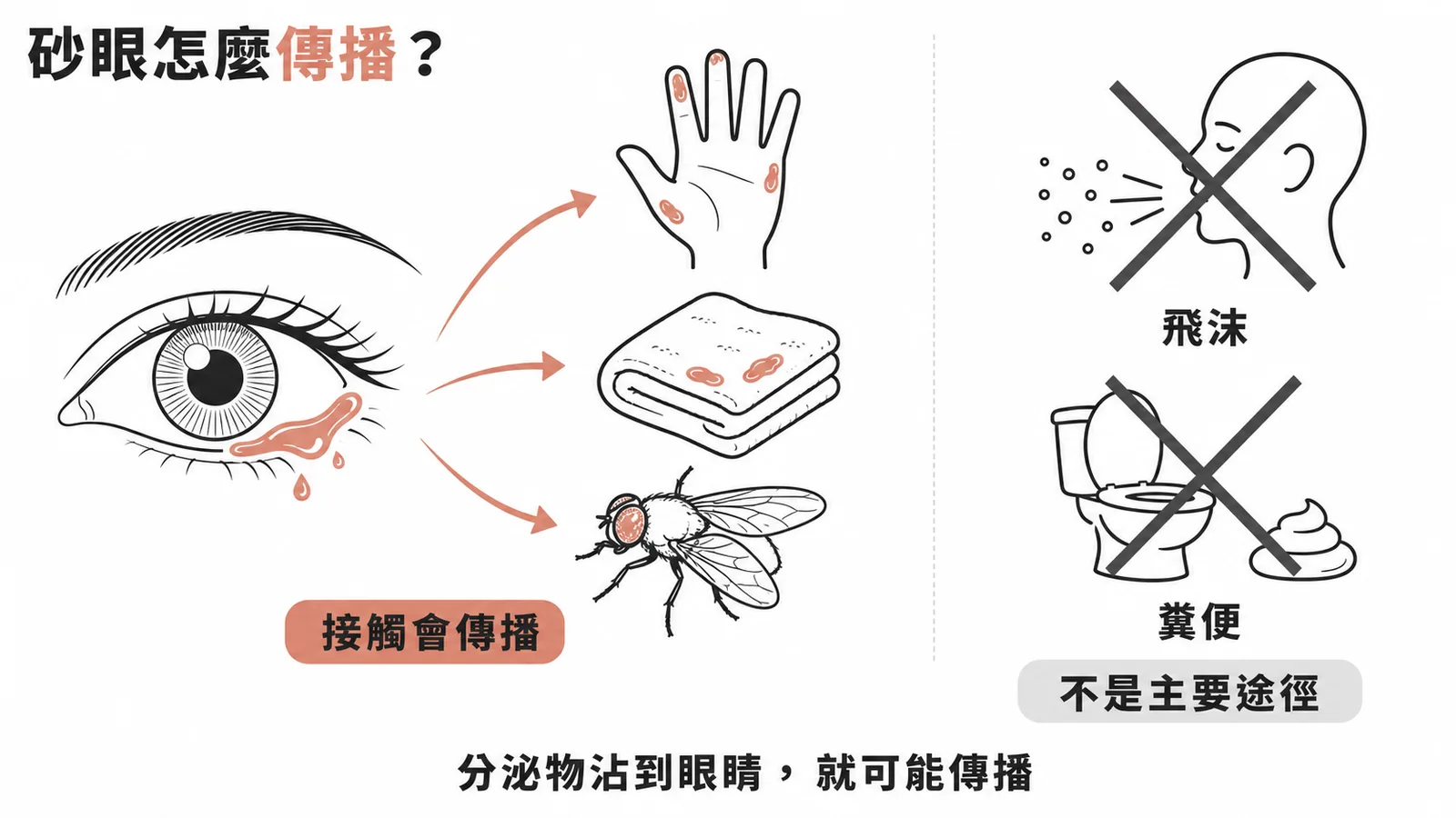 砂眼的傳播途徑:接觸眼睛分泌物傳播,飛沫與糞便非主要途徑