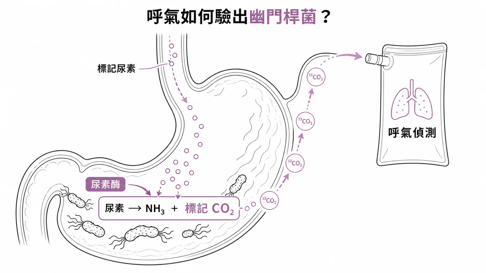 幽門桿菌呼氣測試原理:urease 分解標記尿素產生 CO₂ 由呼氣偵測