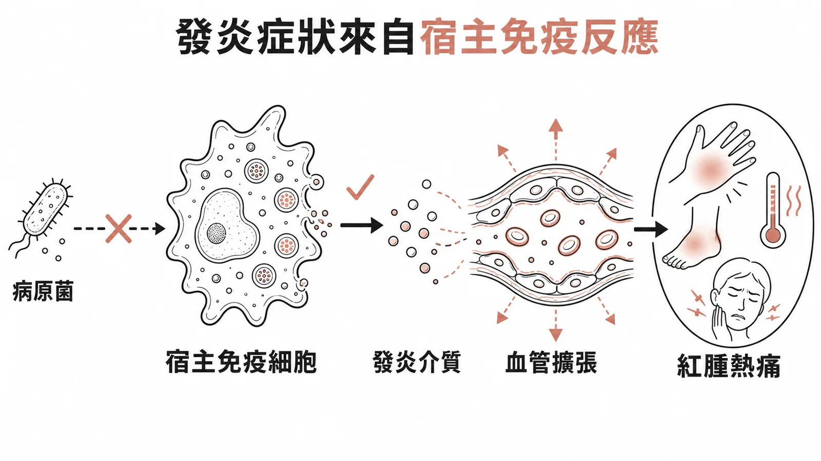 發炎紅腫熱痛源自宿主免疫細胞釋放發炎介質的示意圖