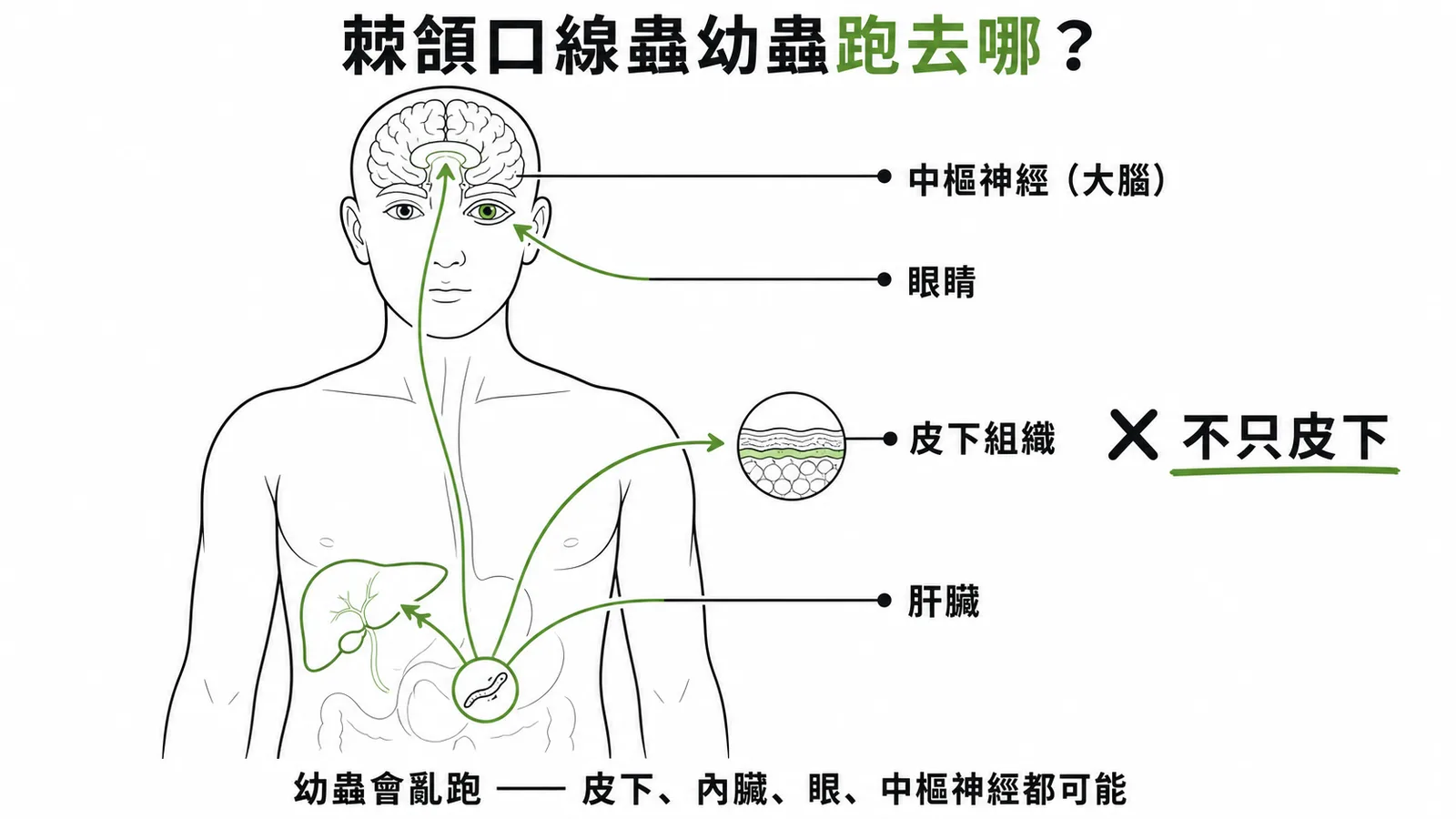 棘頜口線蟲幼蟲移行部位:皮下、內臟、眼、中樞神經皆可能