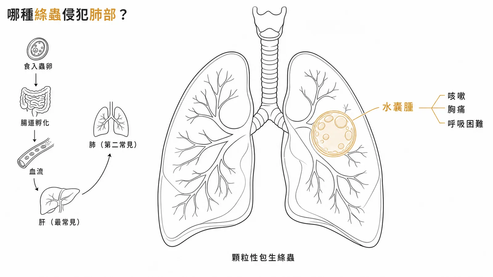 顆粒性包生絛蟲經血流在肺部形成水囊腫的感染路徑