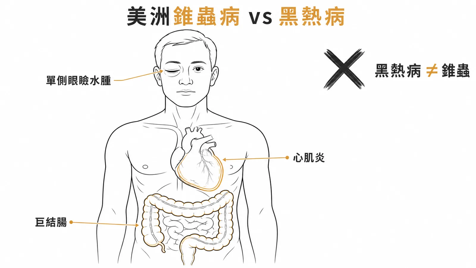 美洲錐蟲病三大表現與黑熱病鑑別