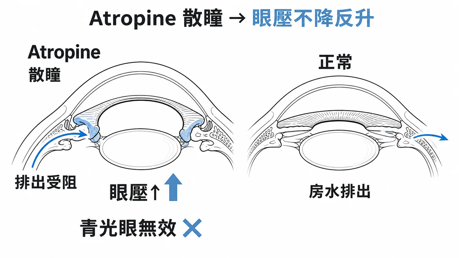 Atropine 散瞳導致房水排出受阻與眼壓上升的眼球截面示意圖