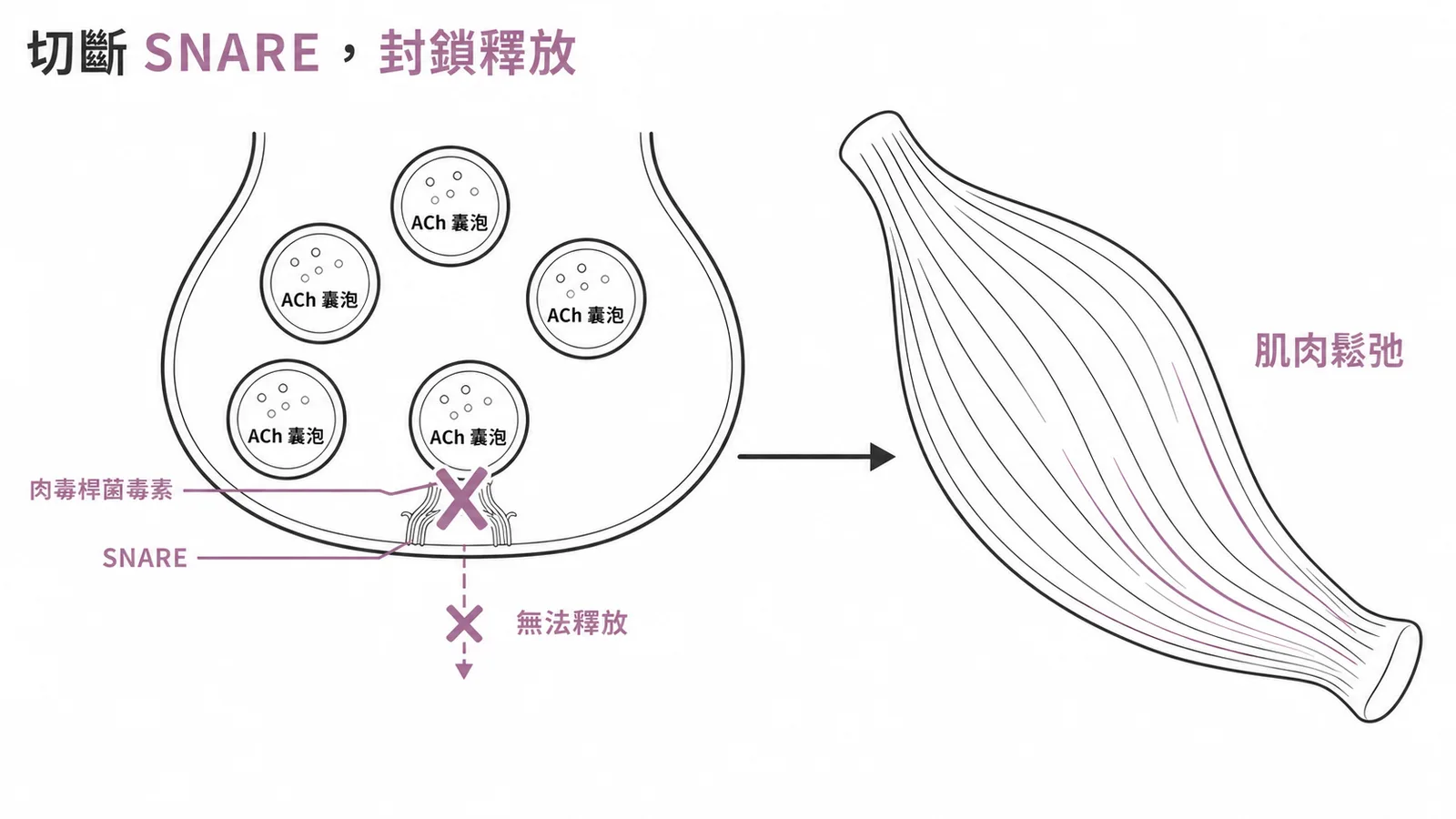 肉毒桿菌毒素切斷 SNARE 蛋白阻止 ACh 囊泡釋放的神經肌肉接合處示意圖