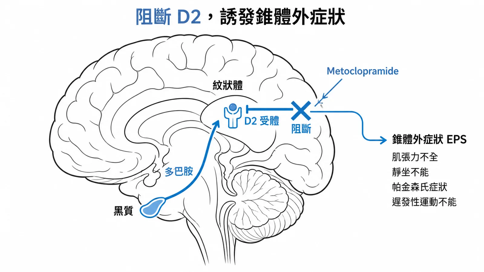 Metoclopramide 阻斷黑質紋狀體通路 D2 受體導致錐體外症狀的大腦示意圖