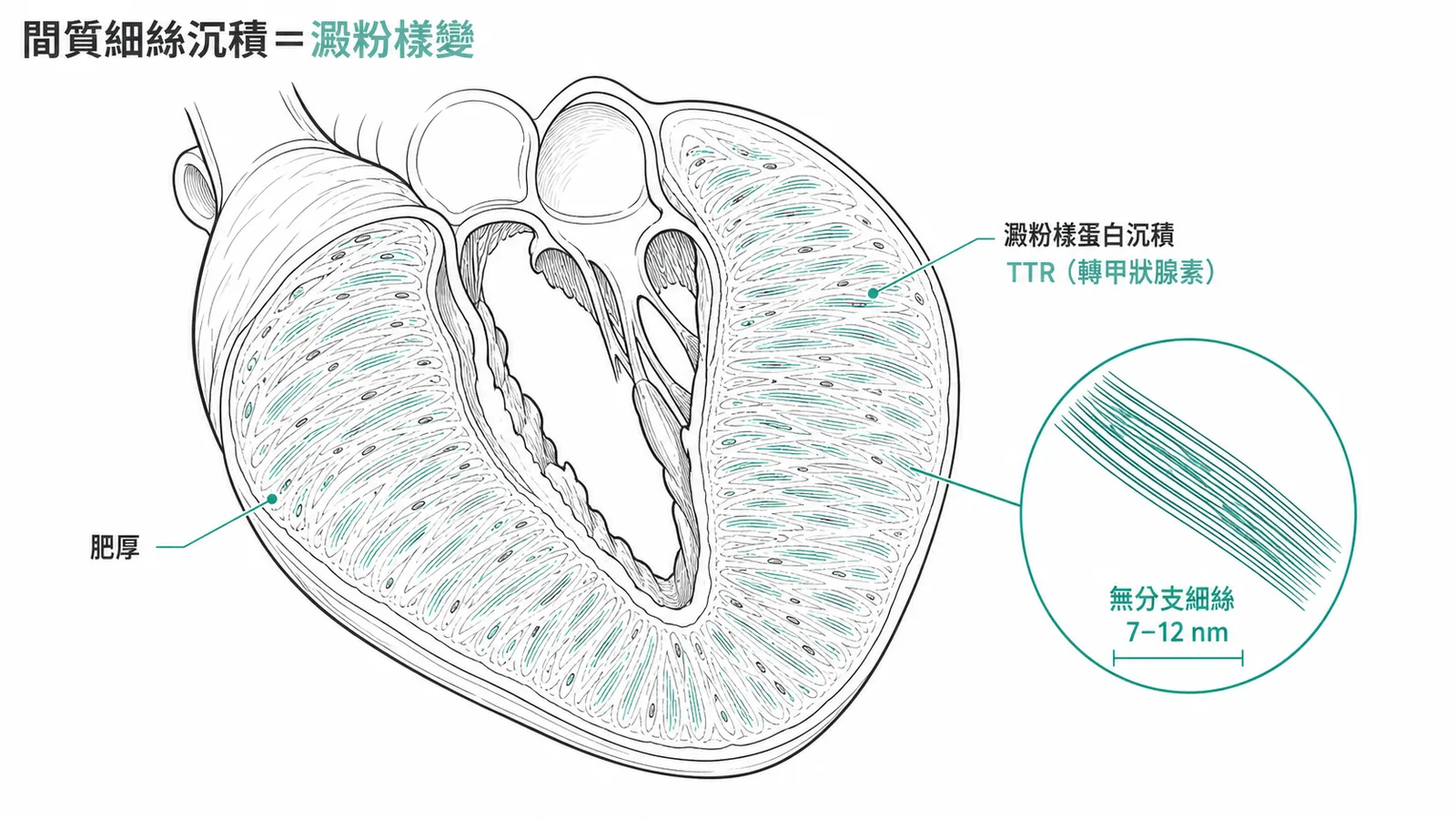 間質細絲沉積等於澱粉樣變：心臟切面顯示心壁肥厚，間質有 TTR 澱粉樣蛋白沉積，放大見無分支細絲 7-12 nm
