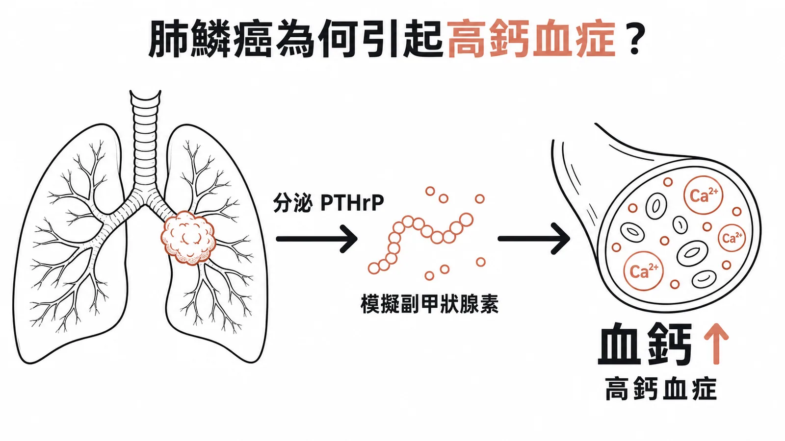 肺鱗狀細胞癌分泌PTHrP導致高鈣血症的機轉流程