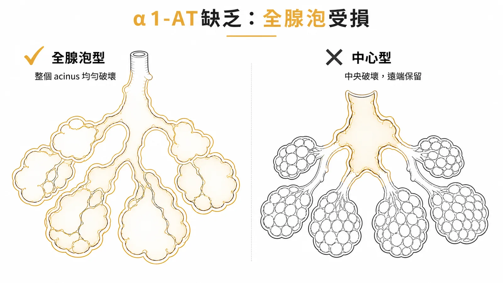 α1-AT缺乏導致全腺泡型肺氣腫——左側全腺泡型整個acinus均勻破壞，右側中心型僅中央破壞