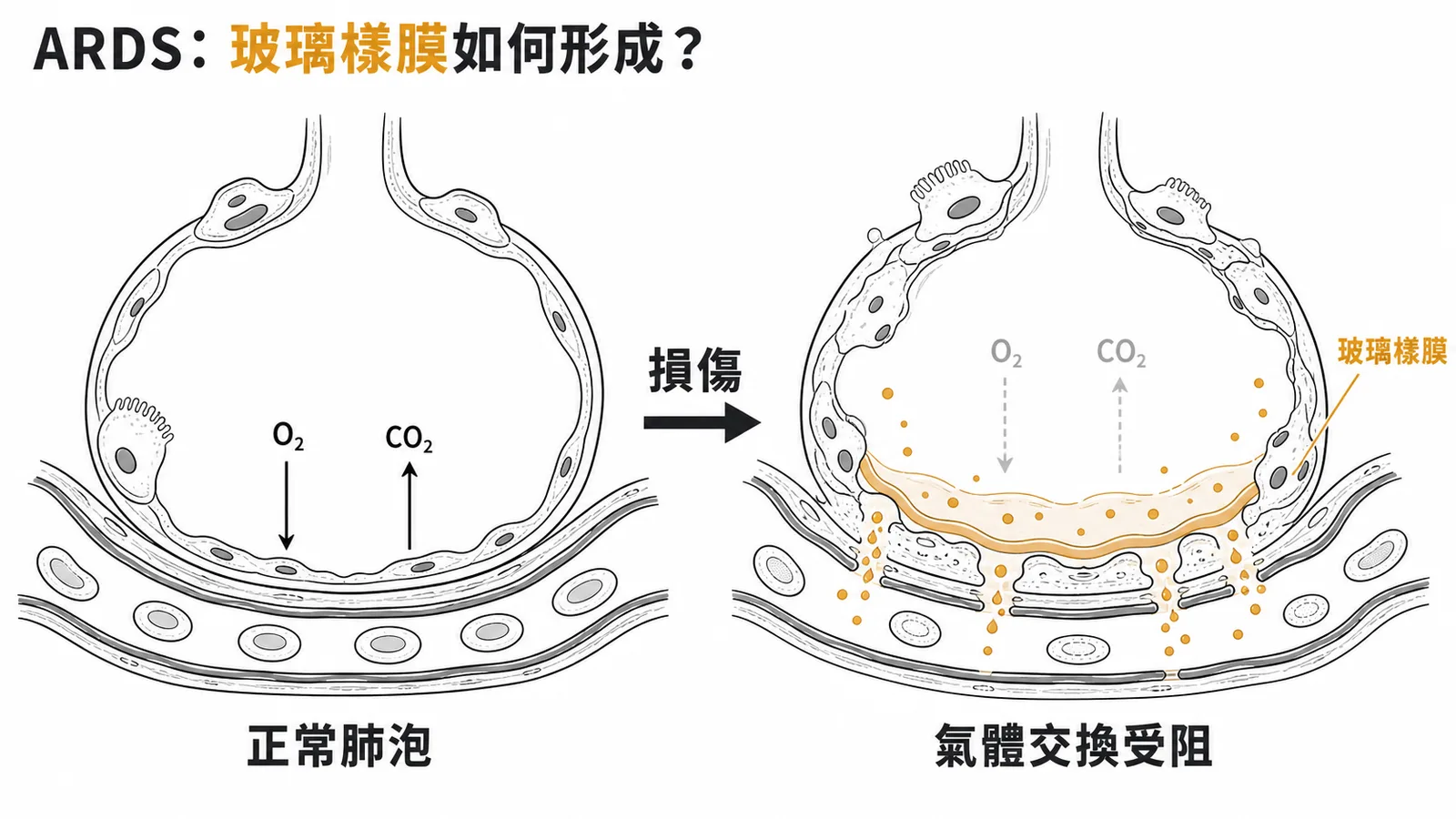 ARDS肺泡玻璃樣膜形成機轉——正常肺泡損傷後蛋白質滲出形成玻璃樣膜阻礙氣體交換