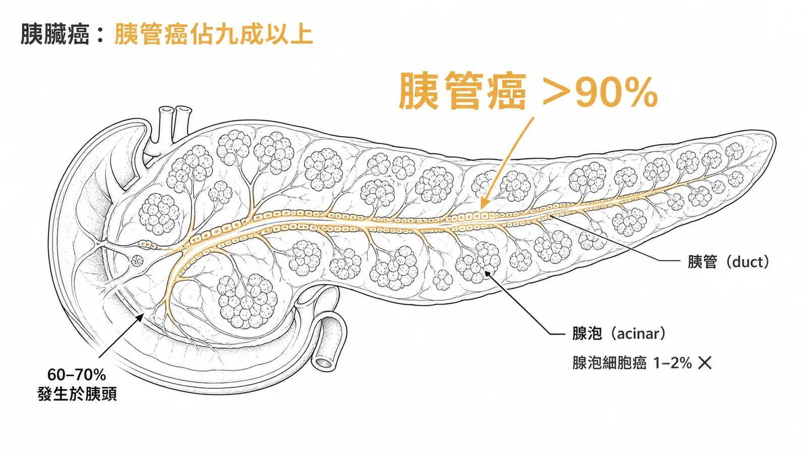 胰臟癌組織來源比例——胰管癌佔九成以上，腺泡細胞癌僅1-2%