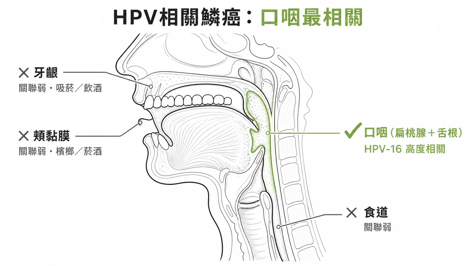 HPV相關鱗狀細胞癌好發部位——口咽部扁桃腺與舌根與HPV-16高度相關