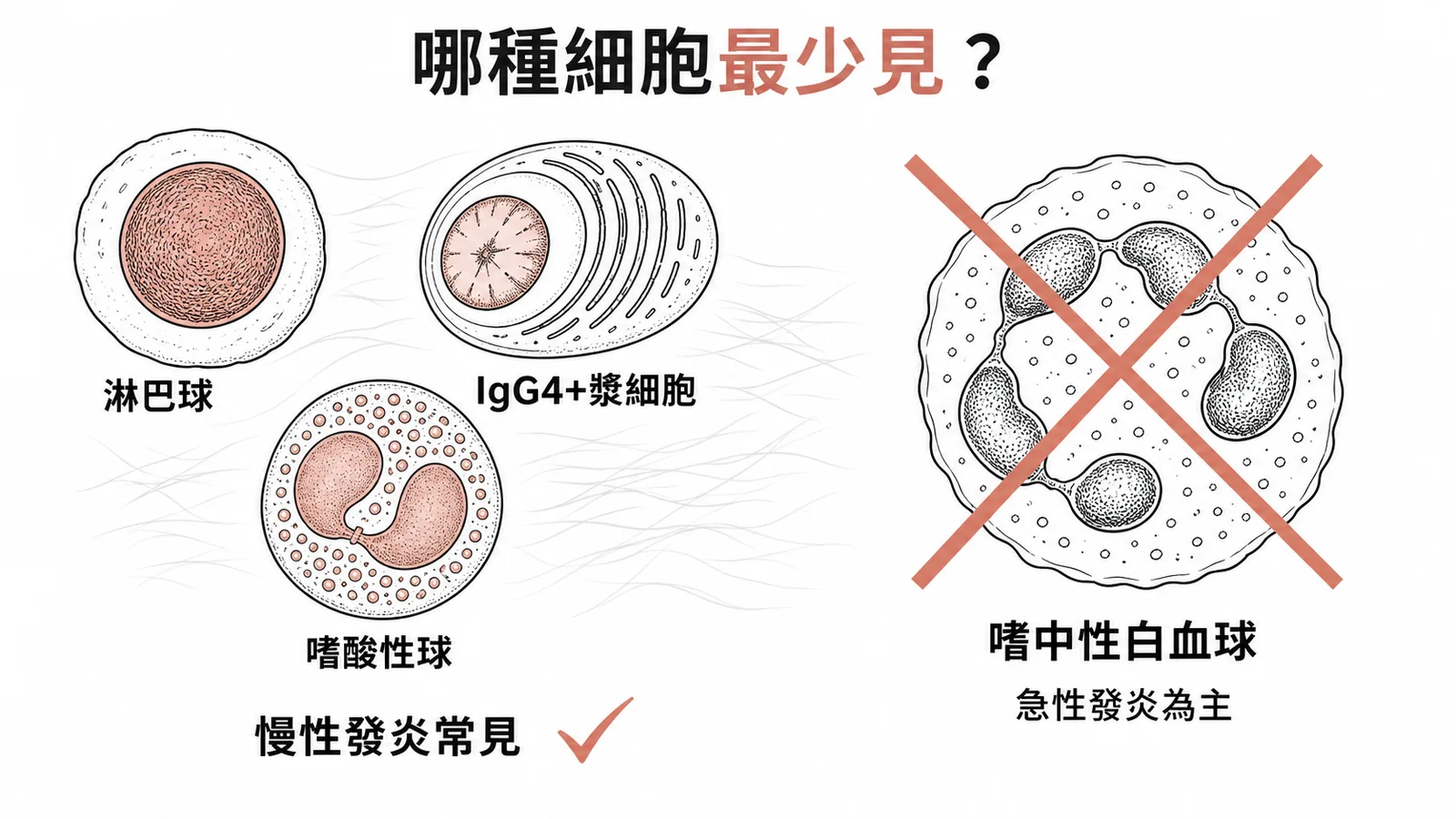 硬化性後腹腔纖維化的炎症細胞——慢性發炎常見淋巴球漿細胞嗜酸性球，嗜中性球最少見
