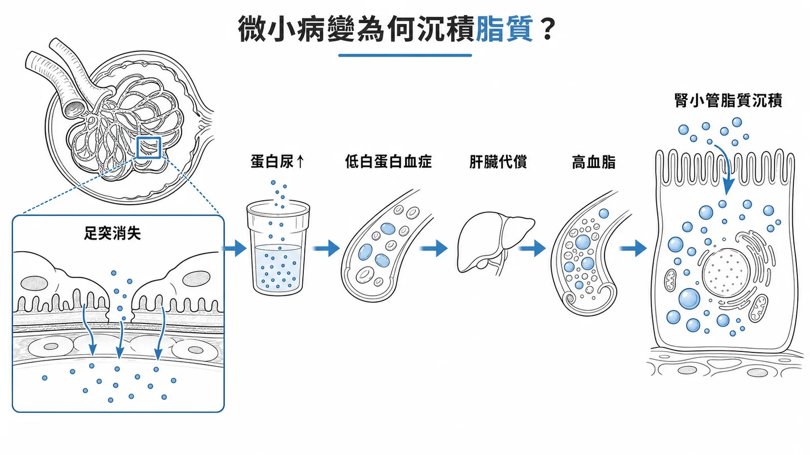 微小病變病理鏈——足突消失→蛋白尿→低白蛋白→高血脂→腎小管脂質沉積
