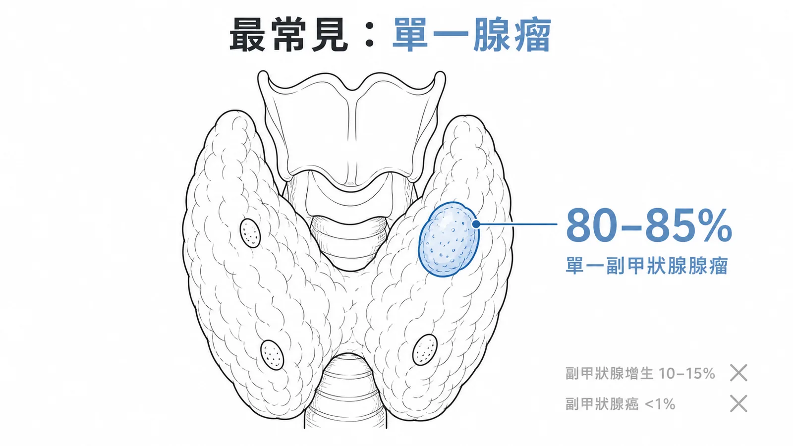 原發性副甲狀腺功能亢進症最常見成因為單一腺瘤（80-85%）