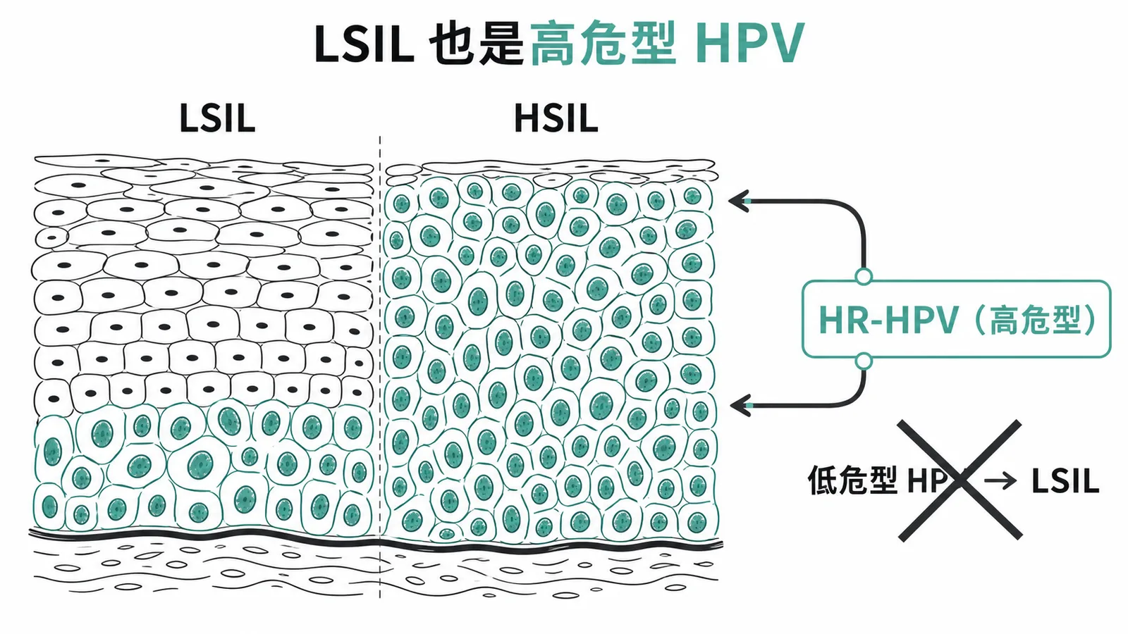 LSIL 與 HSIL 皆主要由高危險性 HPV 引起