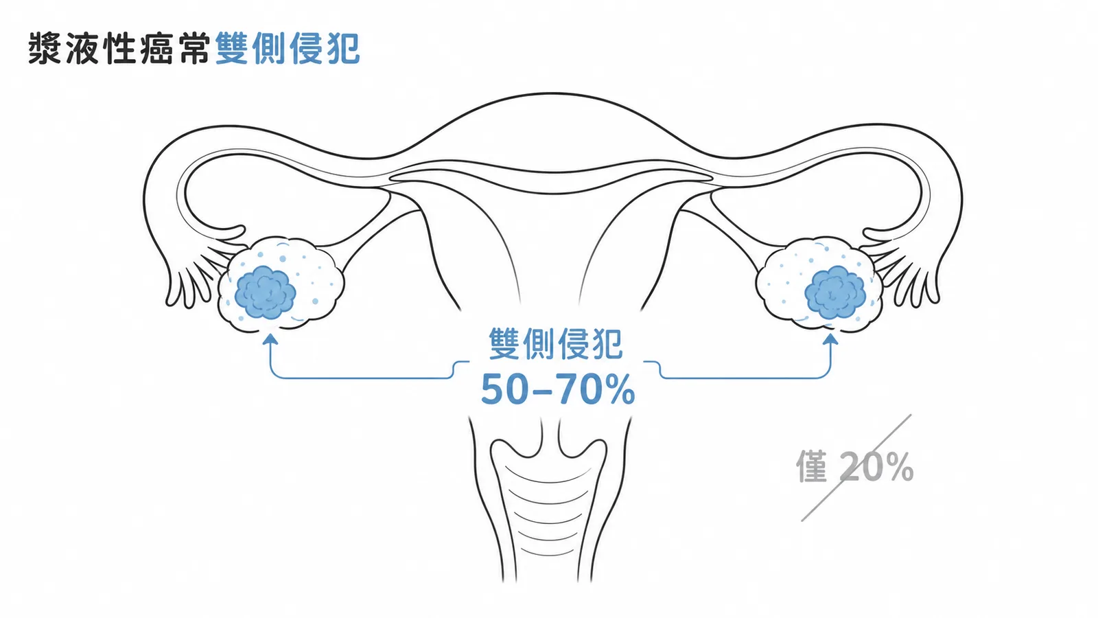 卵巢漿液性癌雙側侵犯比例可達 50-70%