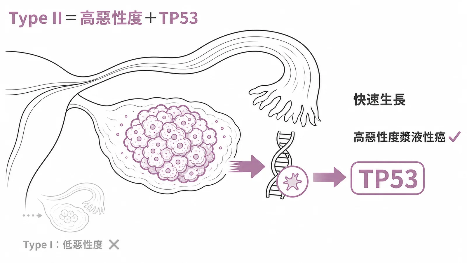 卵巢上皮癌 Type II 為高惡性度漿液性癌，與 TP53 突變相關