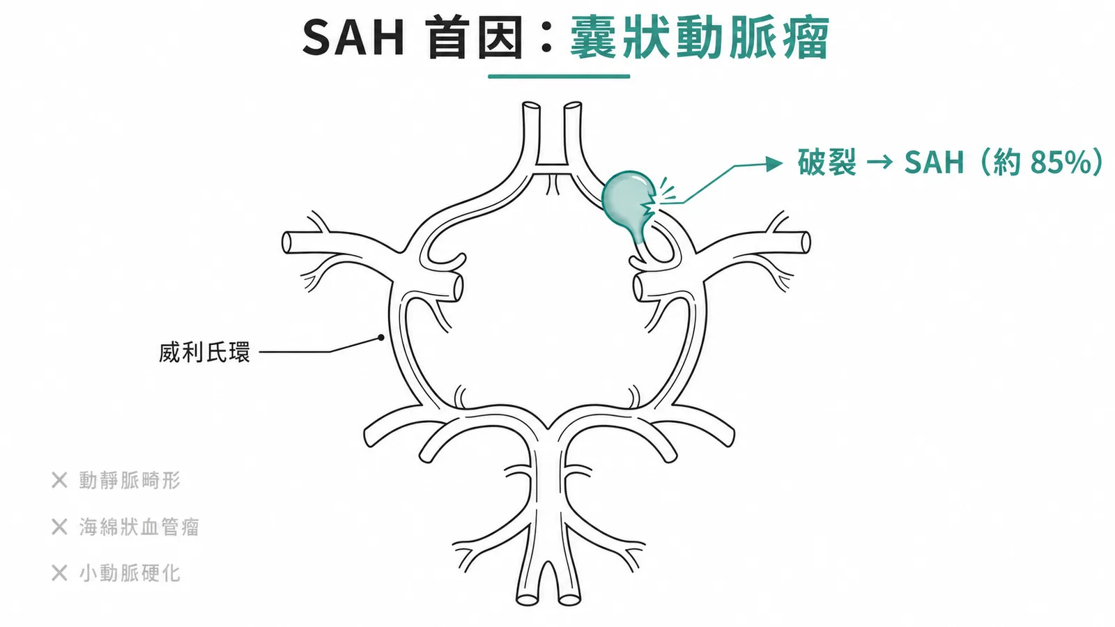 非創傷性 SAH 最常見成因為威利氏環囊狀動脈瘤破裂（85%）