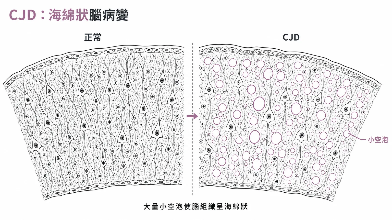 庫賈氏症（CJD）腦組織呈海綿狀空泡病變