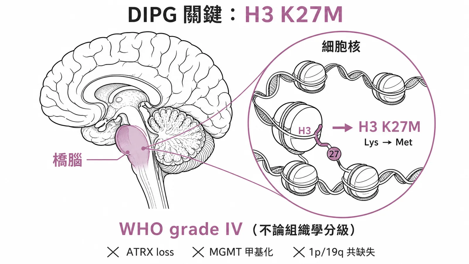 橋腦瀰漫性膠質瘤（DIPG）的標誌基因變化為 H3 K27M 突變
