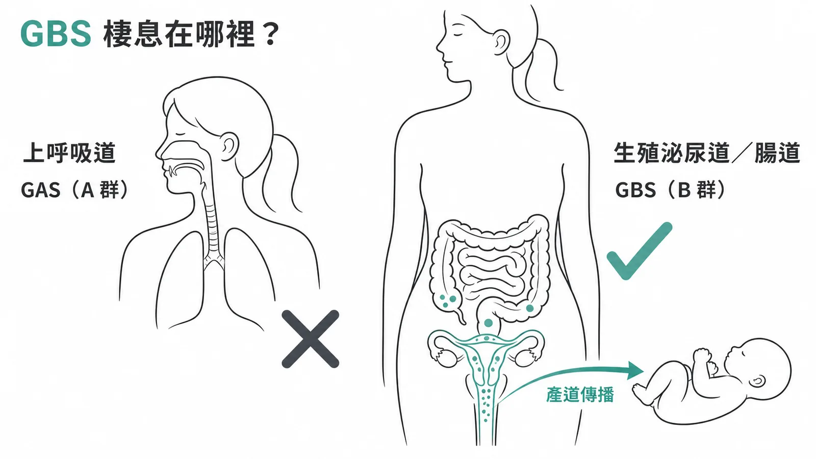 GBS 棲息在生殖泌尿道與腸道而非上呼吸道,可經產道垂直傳播給新生兒