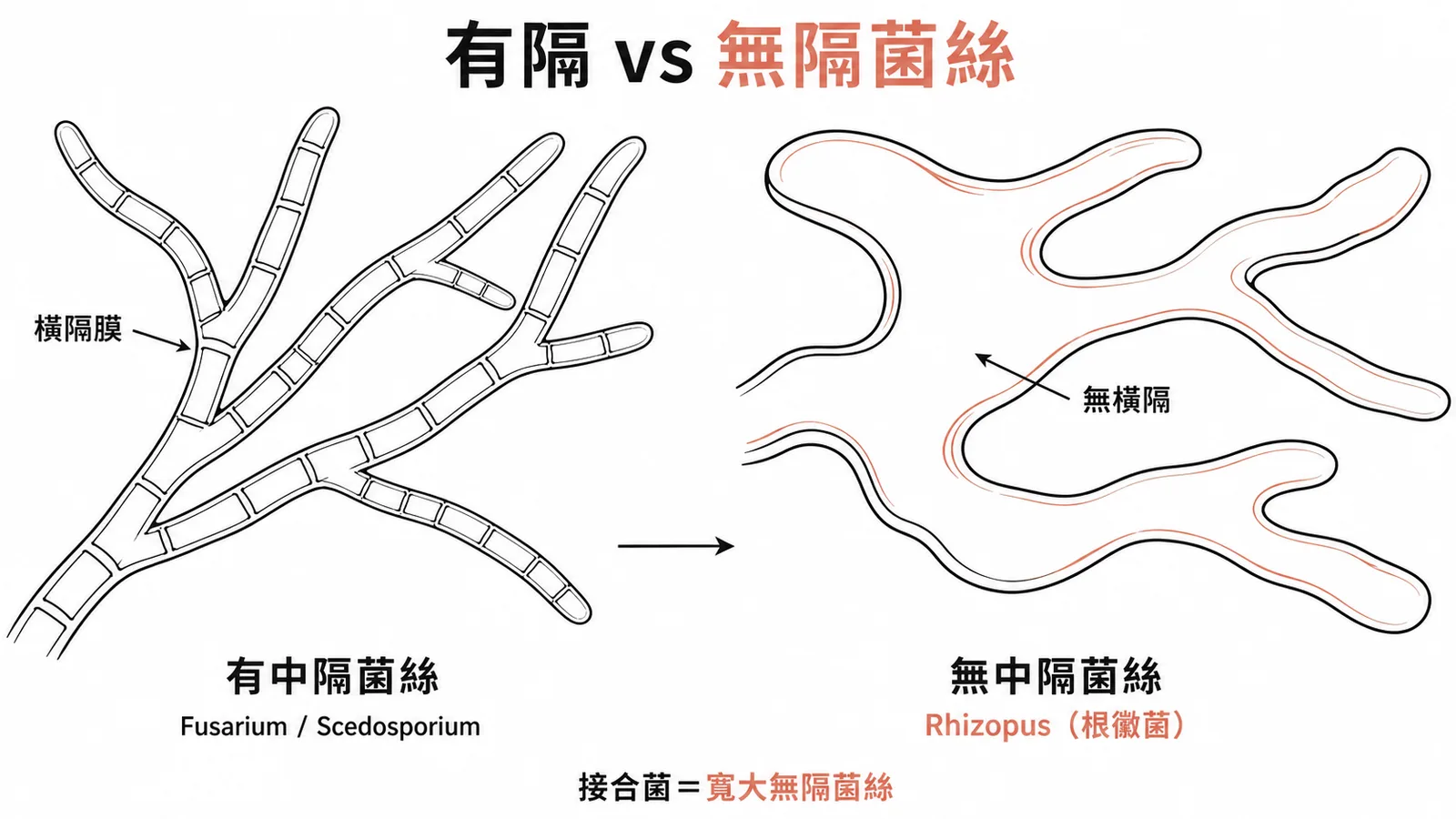 有中隔菌絲(Fusarium、Scedosporium)vs 無中隔寬大菌絲(Rhizopus 接合菌)的形態對照