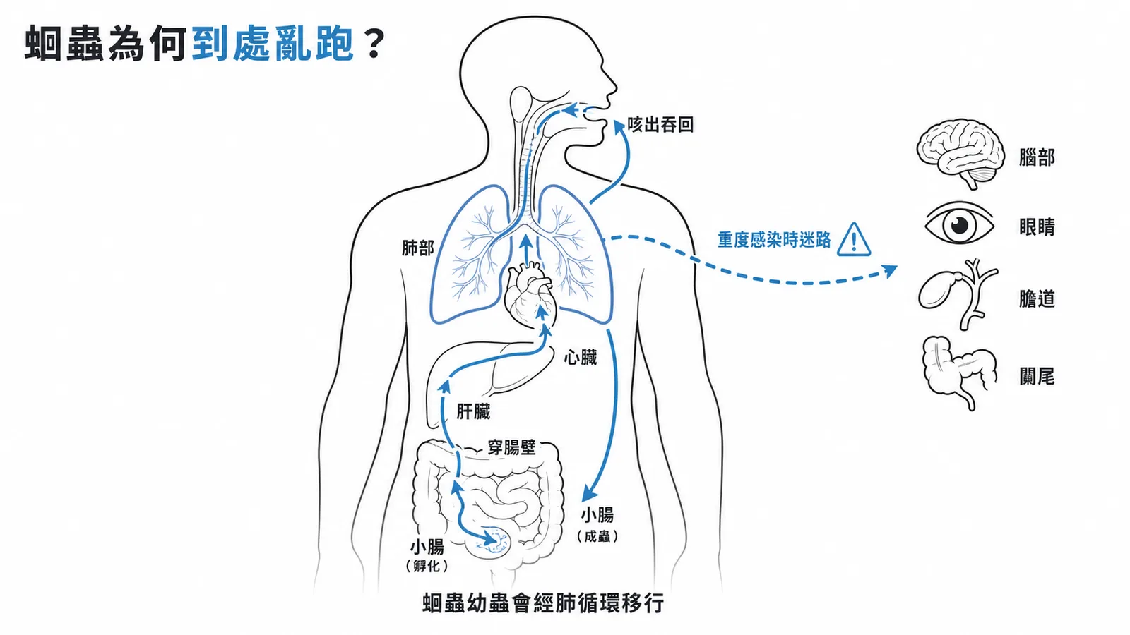 蛔蟲幼蟲經肺循環移行,重度感染時迷路至膽道、腦部等異位器官