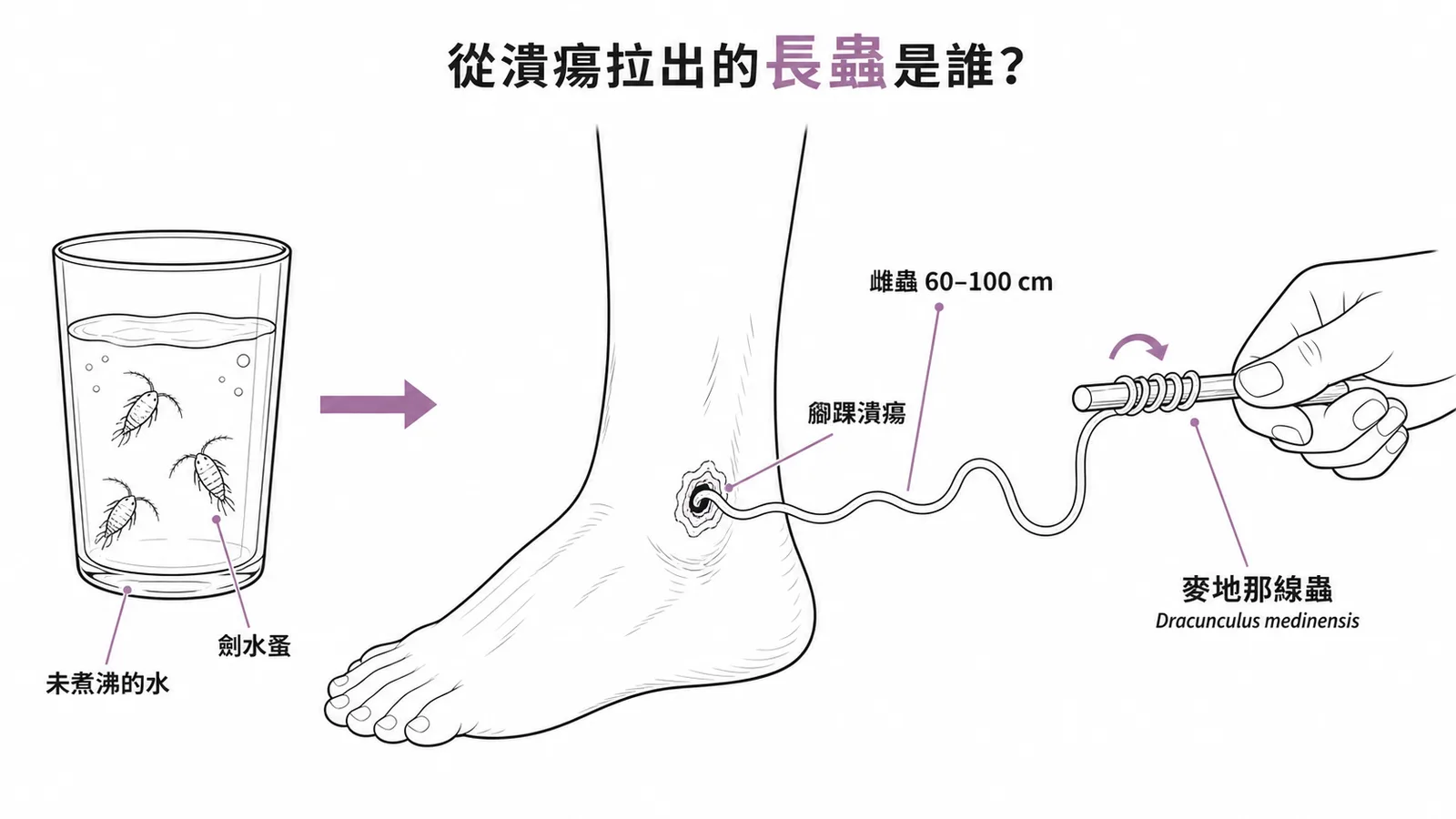 麥地那線蟲經未煮沸的水感染,雌蟲移行至腳踝潰瘍處拉出