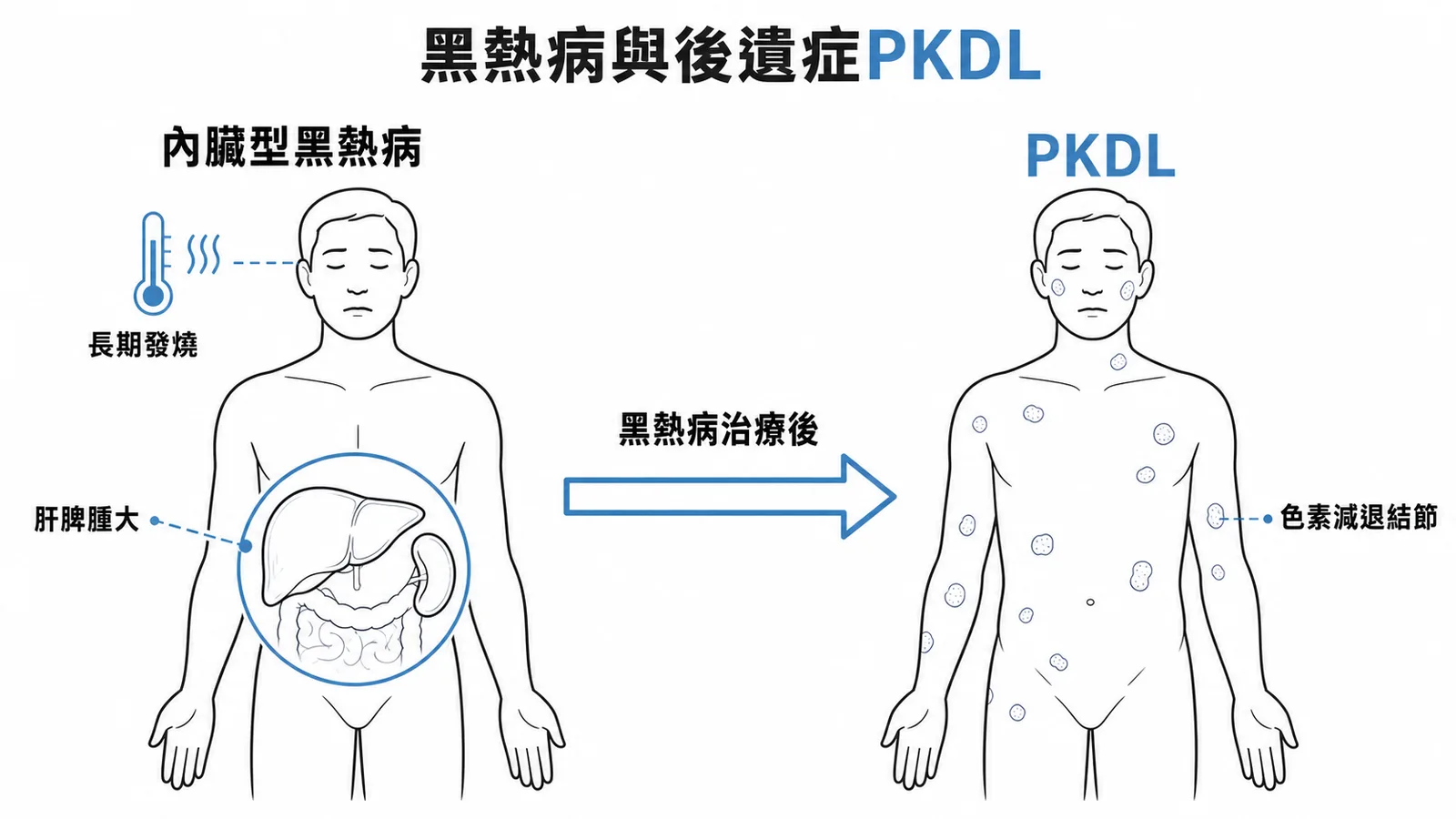 黑熱病與後遺症PKDL:內臟型利什曼病治療後可出現皮膚色素減退結節