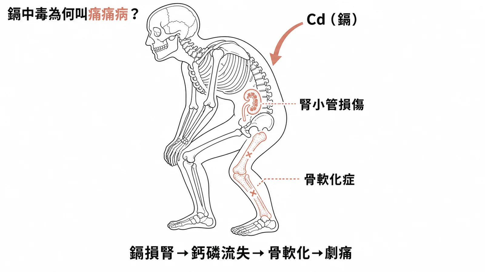 鎘中毒導致骨軟化症(痛痛病)的機轉