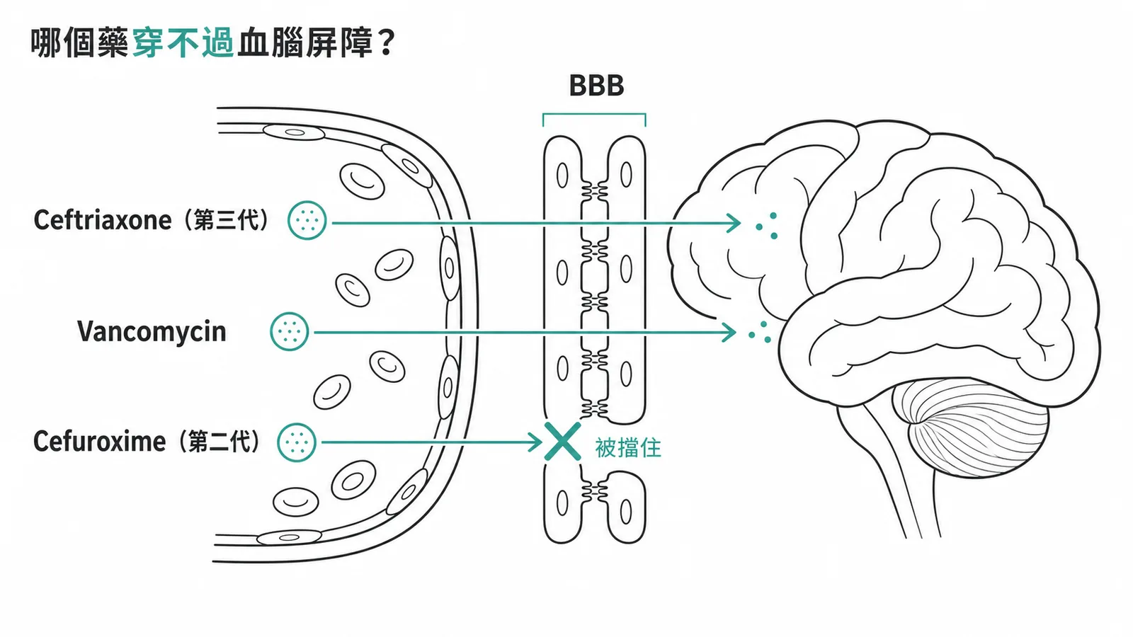 Cefuroxime(第二代頭孢)無法穿透血腦屏障,不適用於腦膜炎治療