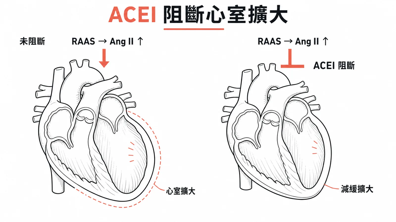 ACEI 阻斷 RAAS 減緩心室擴大與心臟重塑