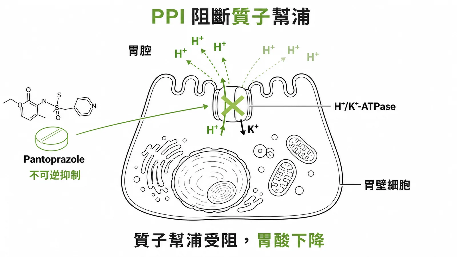 PPI 不可逆抑制質子幫浦降低胃酸治療壓力性潰瘍