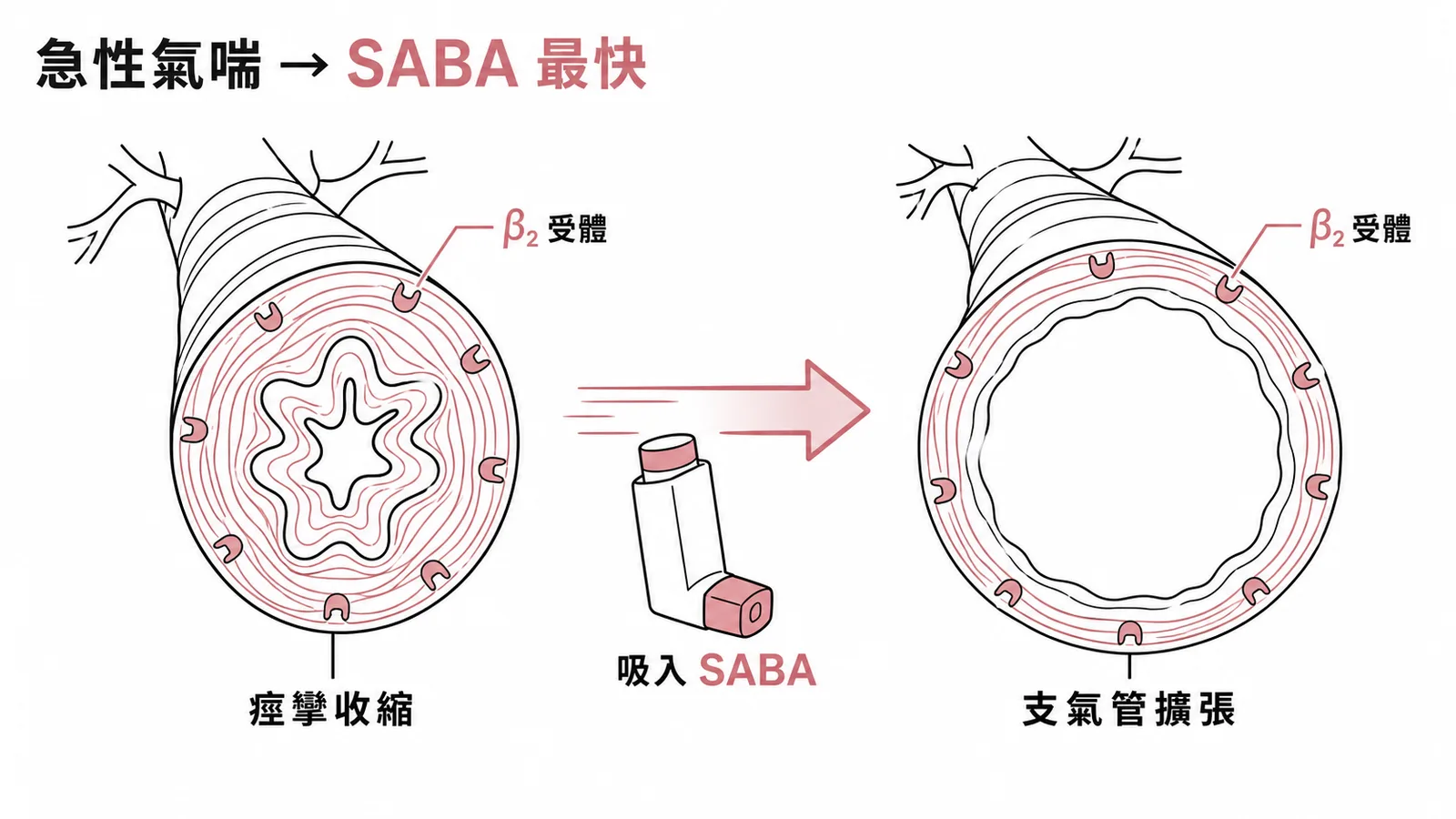 急性氣喘吸入 SABA 快速擴張支氣管